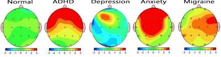 کاربردهای نوروفیدبک برای درمان هر کدام از مشکلات
